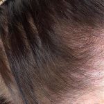 hair thinning - after SMP treatment
