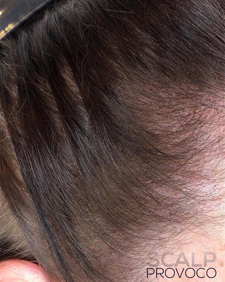 hair thinning - after SMP treatment