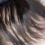 hair thinning - before SMP treatment