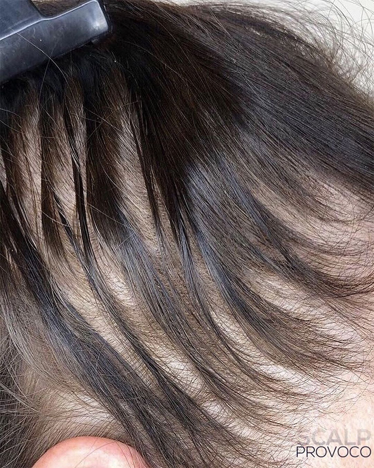 hair thinning - before SMP treatment