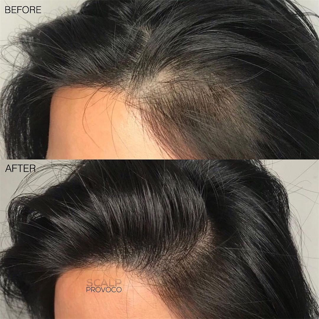 Hair thinning store treatment