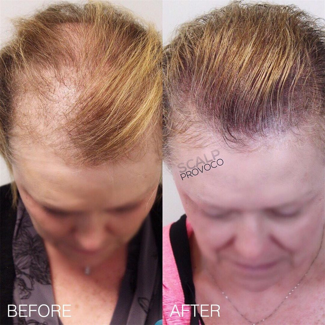 SMP women hair loss