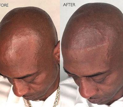 Hair Tattoo  Scalp Micropigmentation  Hair Loss Clinics  Skalp