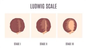 Ludwig Scale for Women