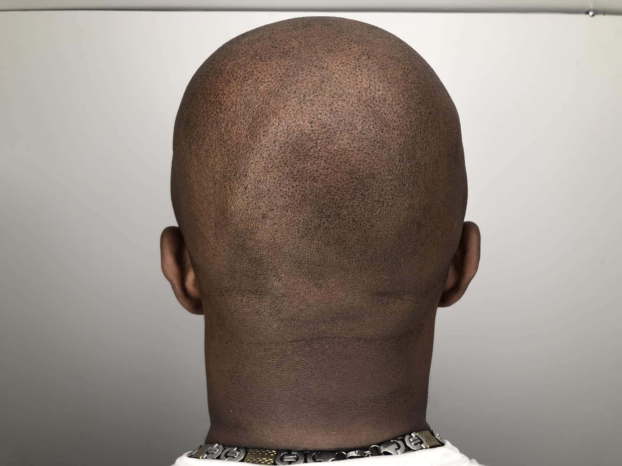 Scalp Micropigmentation Balding Fix Hairstyle Tattoo Image