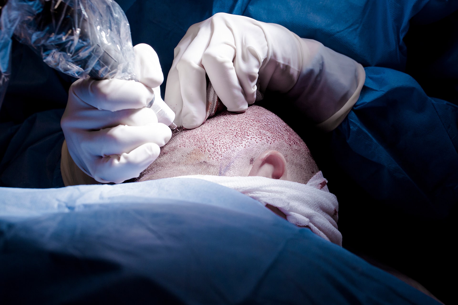 Hair Transplant Scar Treatment With Smp In London