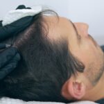 What Is Scalp Micropigmentation