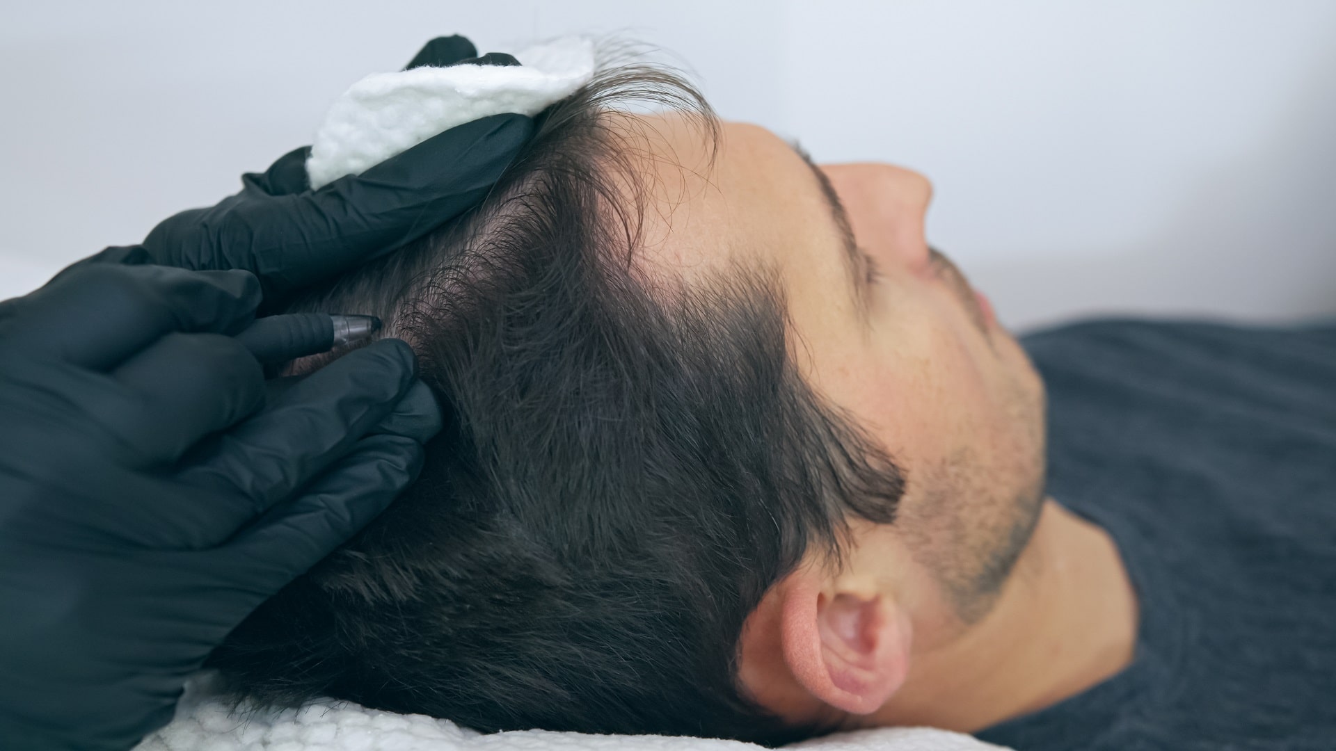 What Is Scalp Micropigmentation