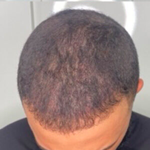 Smp Hair Fill Mens After