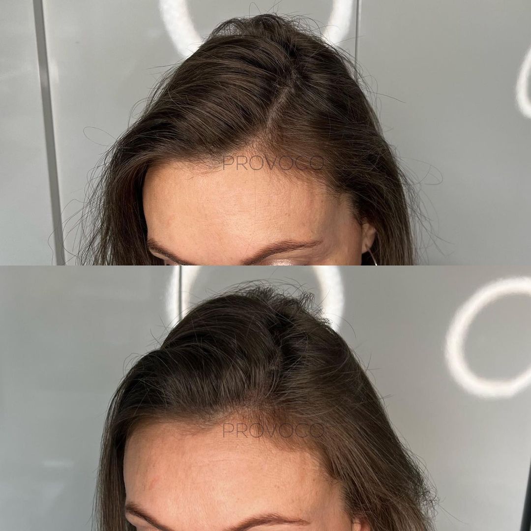 thinning hair vs scalp micropigmentation treatment