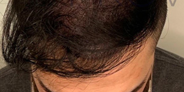 Smp Hair Density Long Scalp Provoco