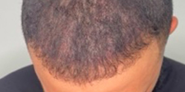 Smp Hair Density Short Scalp Provoco
