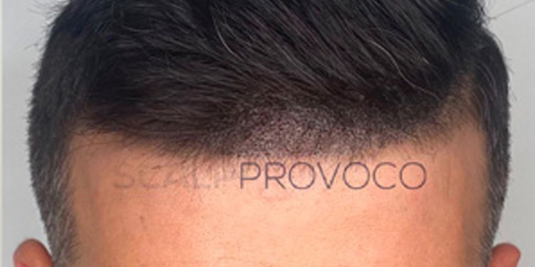 Smp Hair Line Fill Scalp Provoco