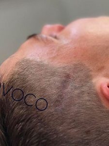 Before After Scar Smp Scalp Micropigmentation 1