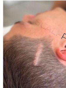 Before After Scar Smp Scalp Micropigmentation 1b
