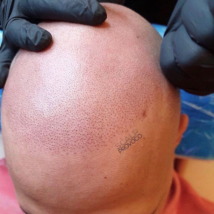 Micropigmentation Healing Just After Treatment