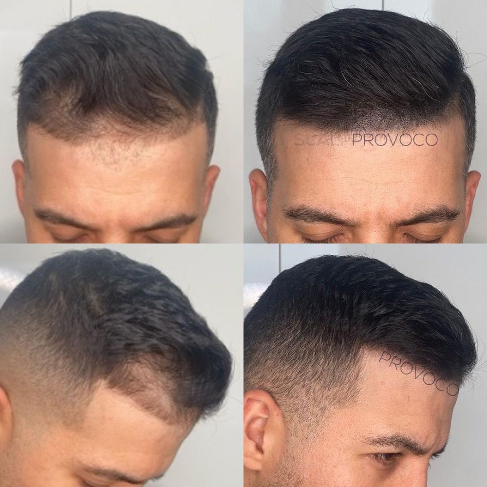 SMP hair treatment for bald or thinning patches