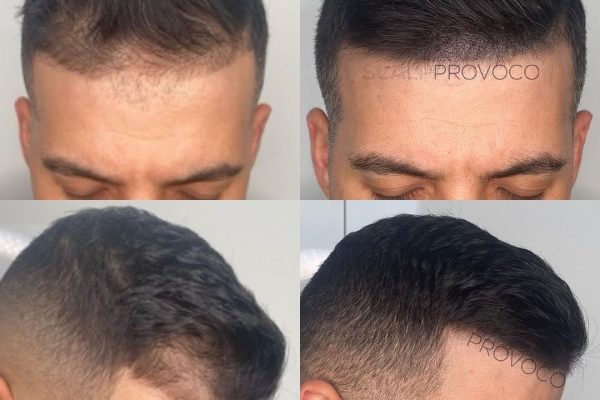 Smp Hair Treatment For Bald Or Thinning Patches