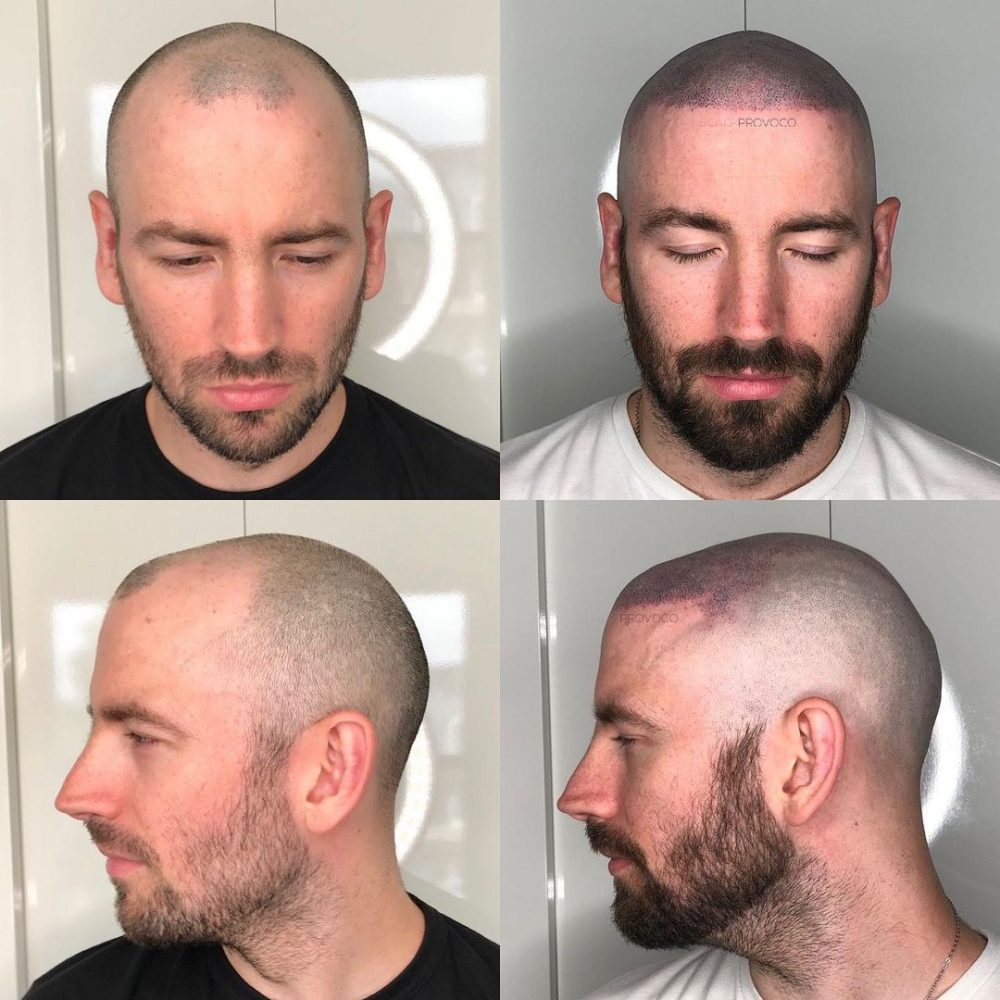Transform receding hairline with SMP
