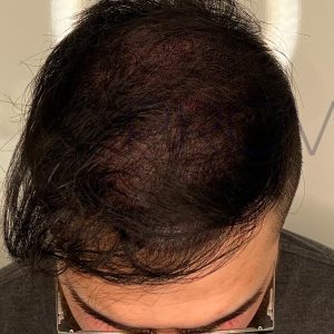 After Smp Long Hair Thinning Procedure