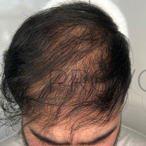 Before Smp Long Hair Thinning Procedure