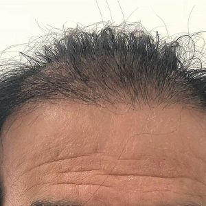 Before Smp Long Hair Thinning Procedure 3a
