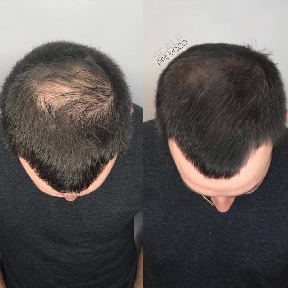 Mens post hair transplant to thicken hair