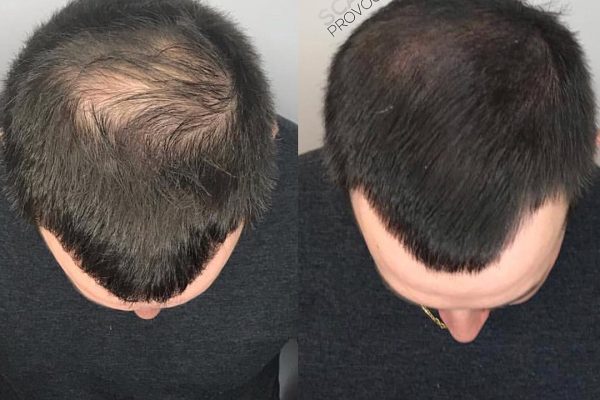 Mens post hair transplant to thicken hair