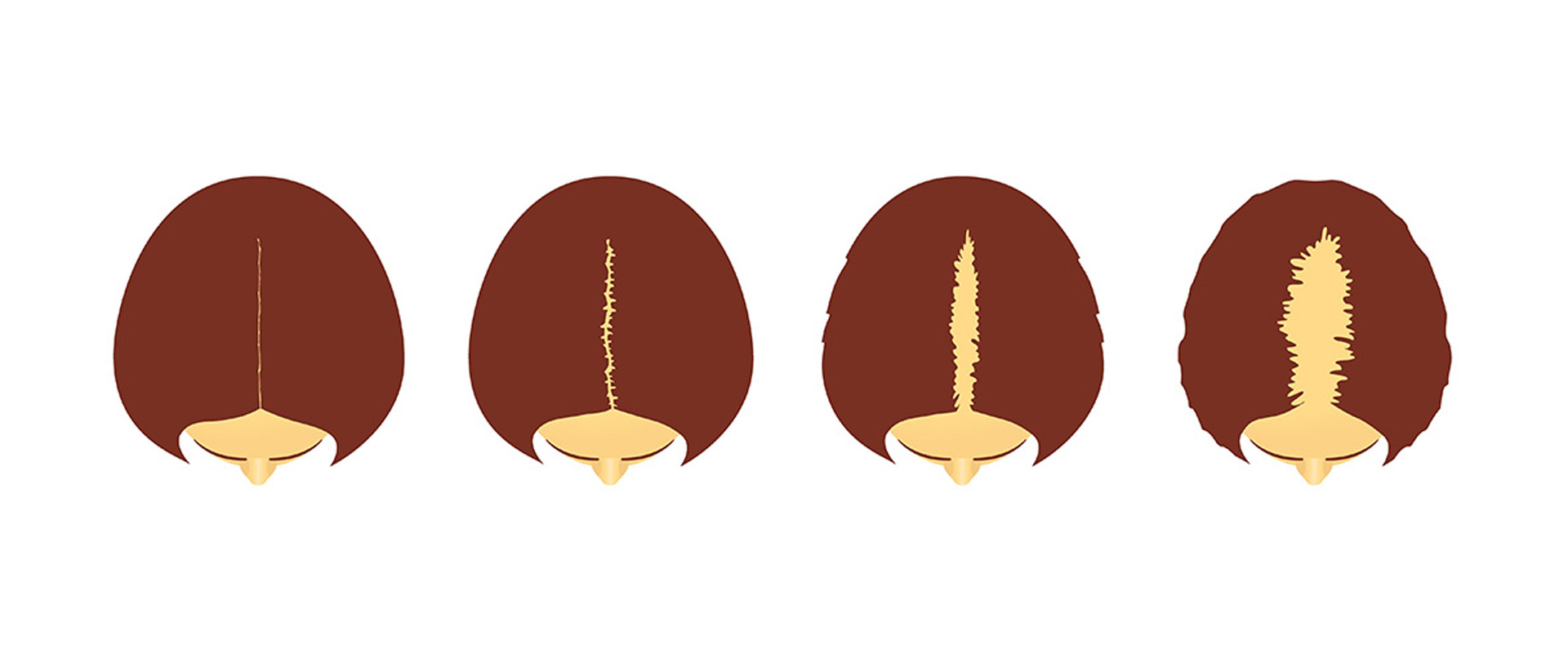 Female Pattern Hair Loss Fphl Stages Illustration