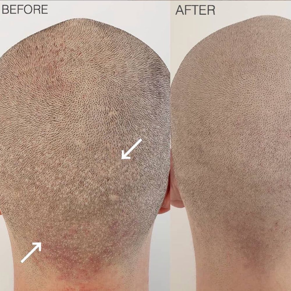 Hair transplant FUT scar coverage before after