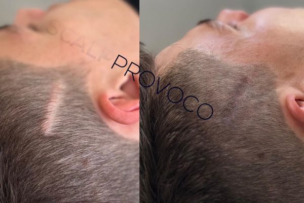 Injury Scar Smp Scalp Coverage Provoco