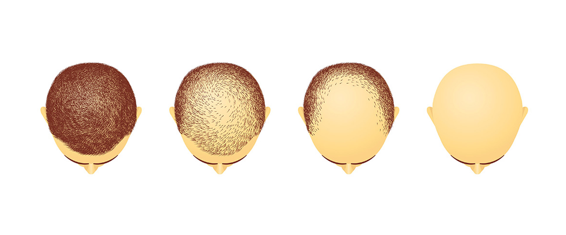 Male Pattern Baldness Stages Illustration