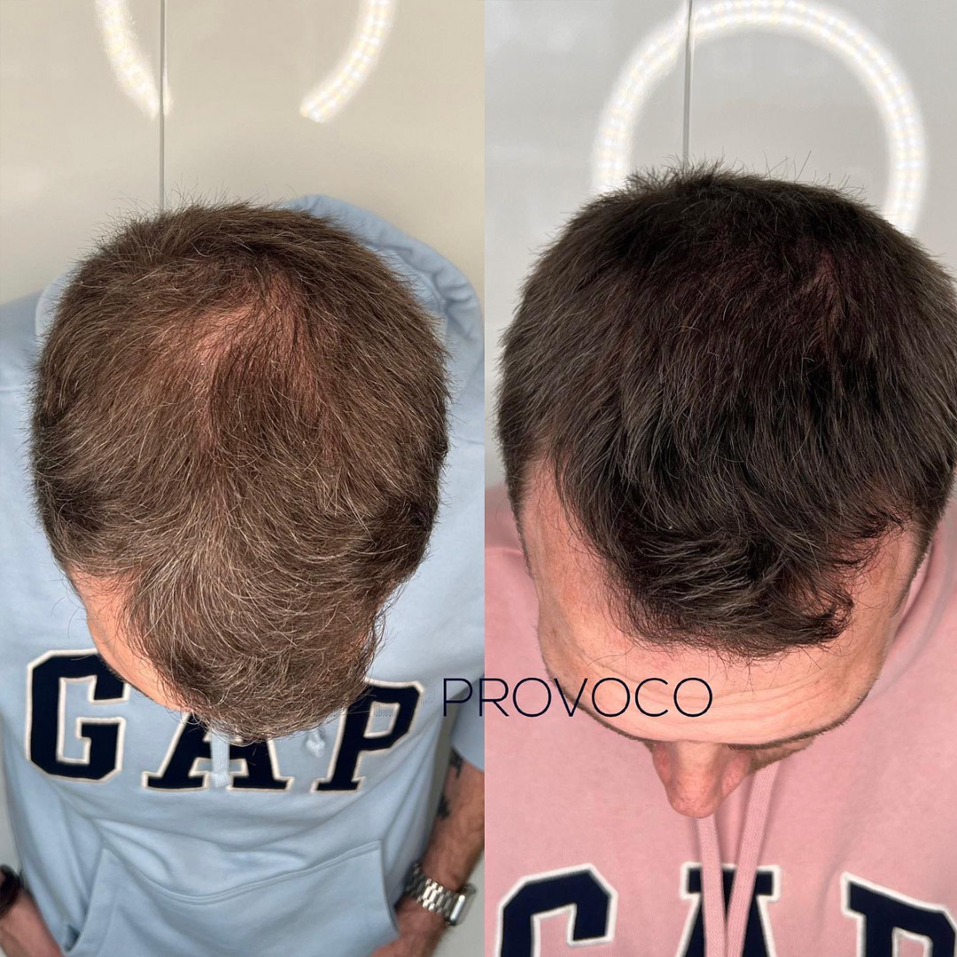 Receding Hair Density Crown Smp Provoco 1