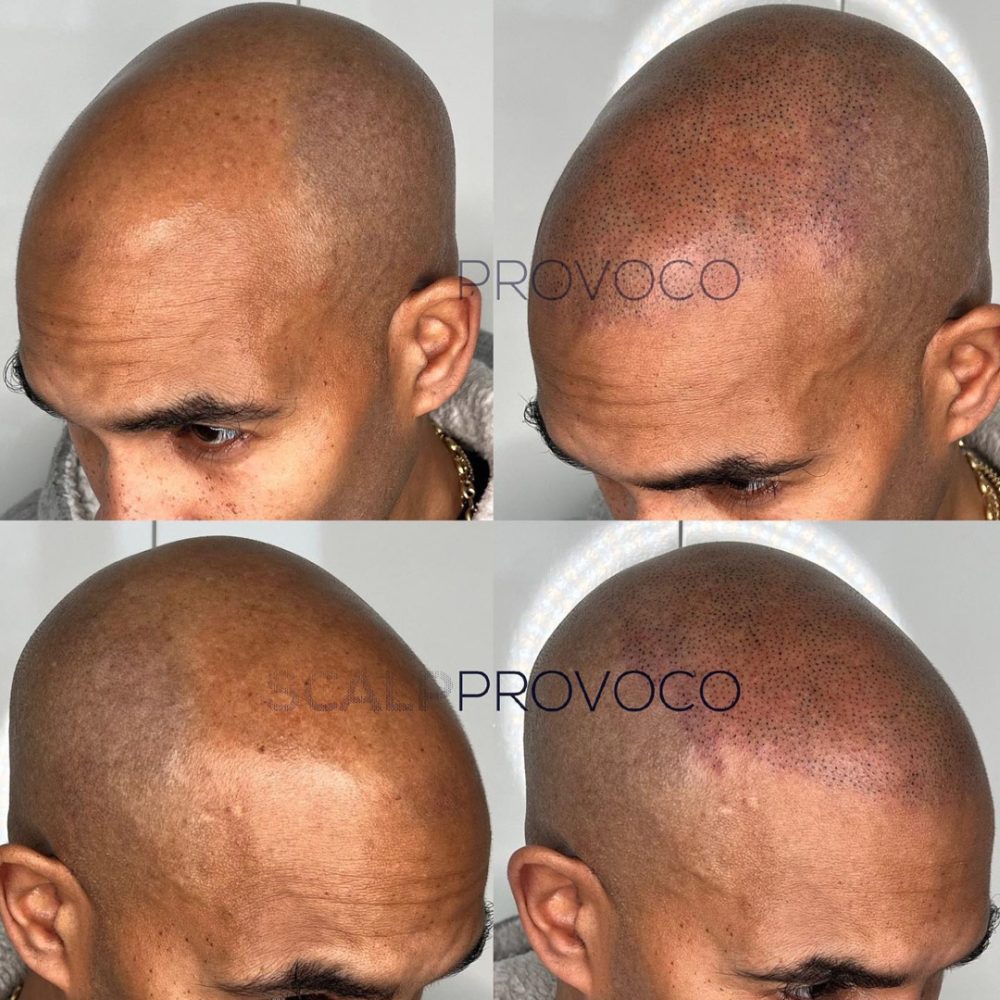 Scalp micropigmentation cover bald area