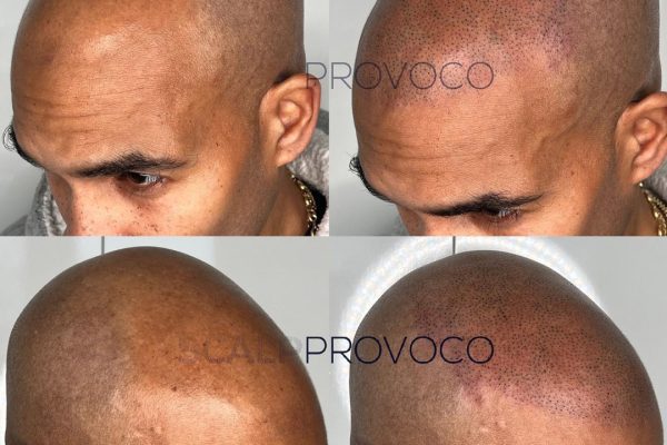 Scalp Micropigmentation Bald Coverage New Hairline Provoco