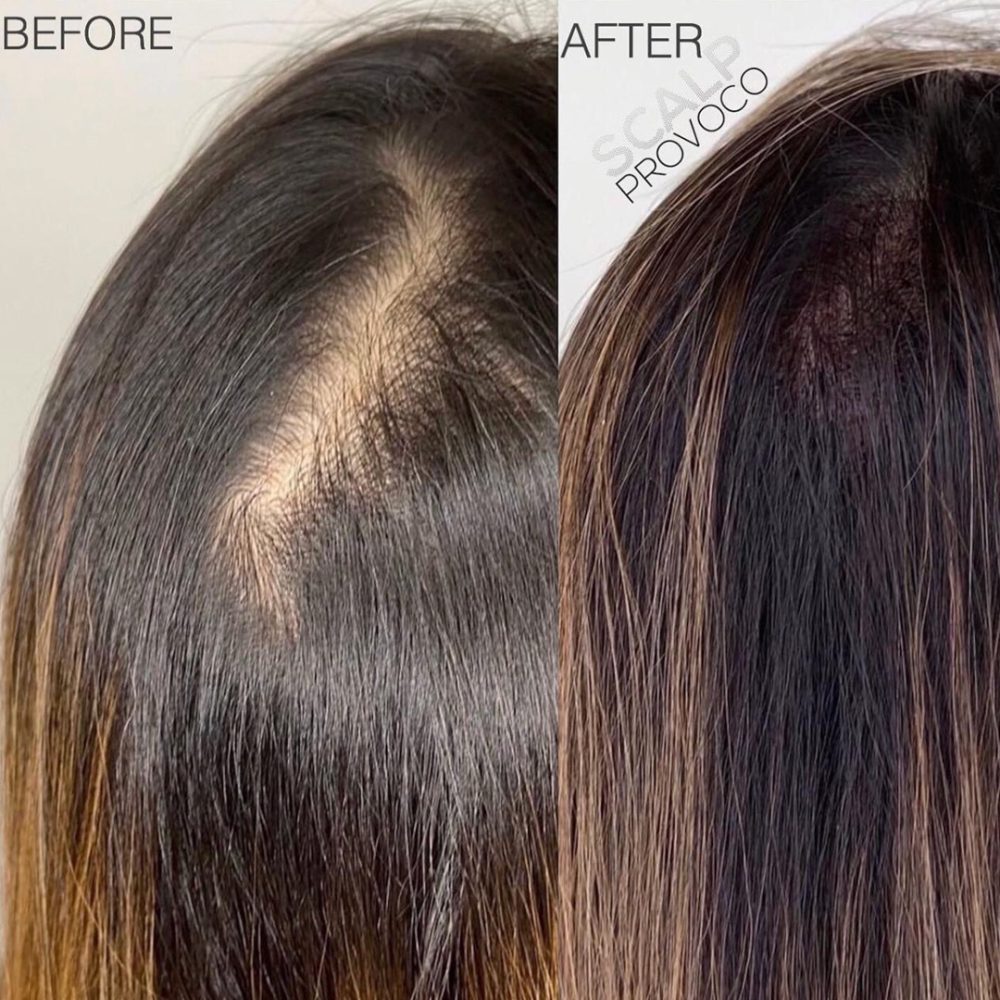 Women with thinning hair on crown uses scalp micropigmentation