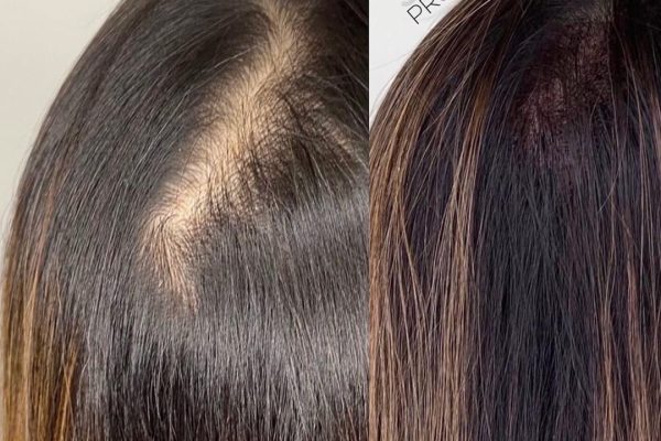 Women with thinning hair on crown uses scalp micropigmentation