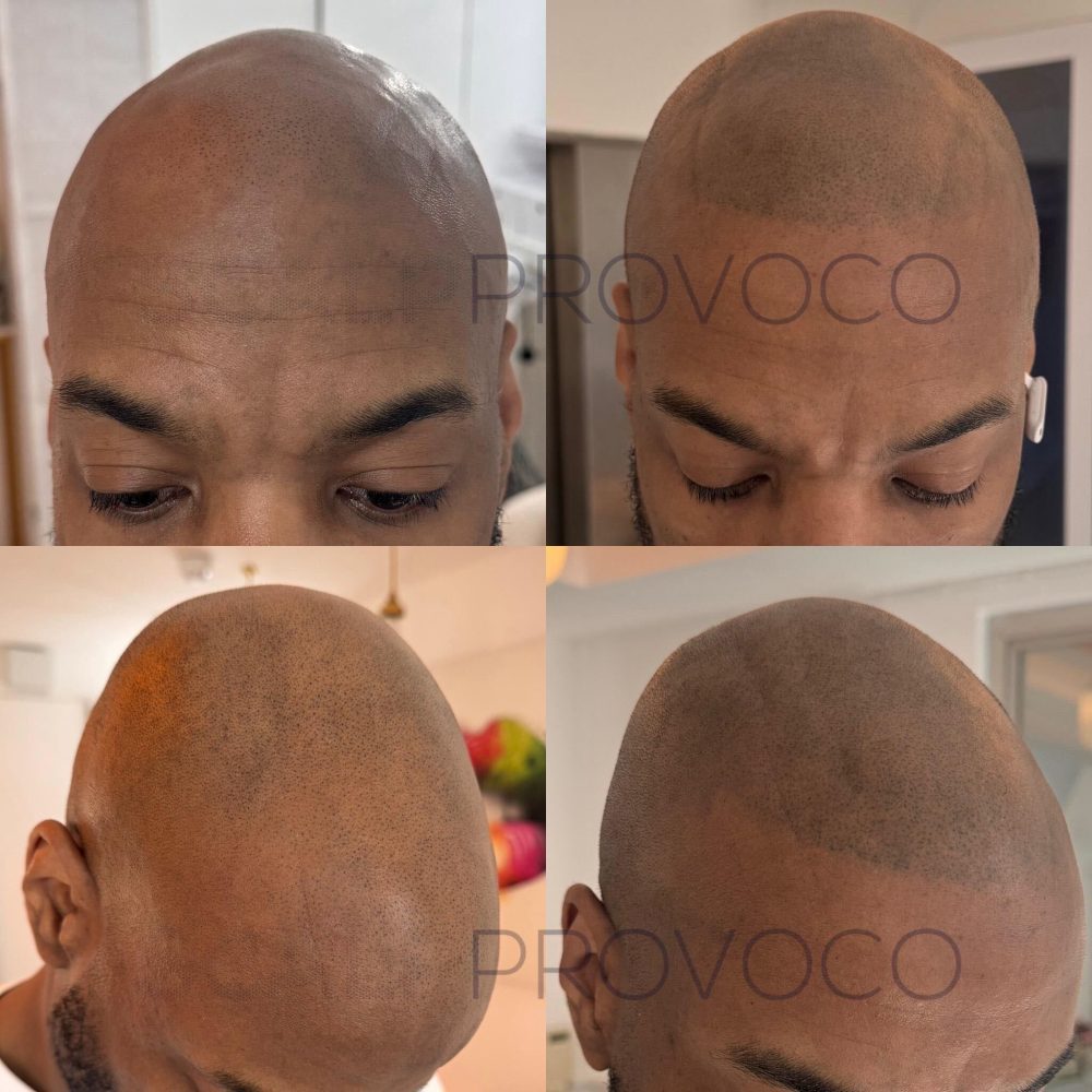 SMP for an even hairline and full shaved head look