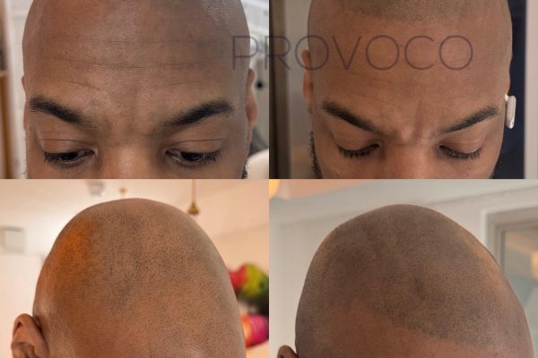 SMP for an even hairline and full shaved head look
